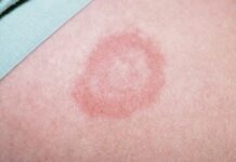 Бляшки на коже. Разновидности образований и их характеристики