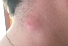 Болит шишка: возможные причины боли, разновидности новообразований