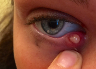 У ребенка на глазу долго не проходит ячмень на глазу