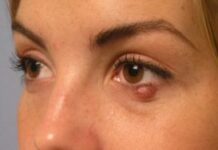 Как долго проходит ячмень на глазу — ОНЛАЙН БОЛЬНИЦА