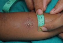 Гиперемия манту или покраснение манту без папулы — что это такое — Поликлиника №8