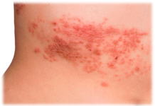 Опоясывающий лишай (герпес)