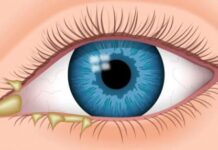 Гнойная инфекция глаза: описание болезни, причины, симптомы, стоимость лечения в Москве | метро Полянка, Серпуховская, Добрынинская