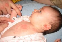 Розеола у детей — что за заболевание и как отличить от аллергии? | Детская поликлиника