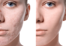 Чем убрать шрамы и рубцы на лице — Семейный косметологический центр