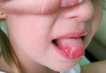 Язвы на языке сбоку причины чем лечить — ПрофиМед — эстетическая стоматология