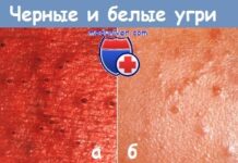 Акне (прыщи) у детей и их дифференциация