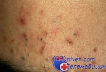 Как убрать черные точки на лбу? Причины появления комедонов