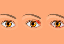 Ячмень на глазе. Симптомы, причины и лечение ячменя на глазе, лечение в Москве — Девита (Devita)