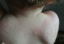 Детская розеола симптомы, лечение, описание