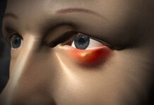 Ячмень на глазу: 8 актуальных и безопасных способов борьбы