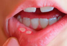 Стоматит, лечение стоматита, фото и виды заболевания