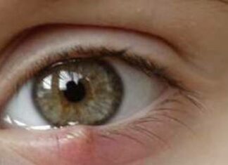 Как вылечить ячмень на глазу за 1 день — народные средства от ячменя на глазу