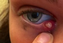 Сколько длится ячмень на глазу. Лечение ячменя на глазу медикаментами — Семейная клиника ОПОРА г. Екатеринбург