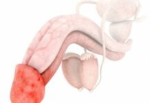 Покраснение головки у мужчин: что это может быть и что делать | Клиника Dr. AkNer в Москве