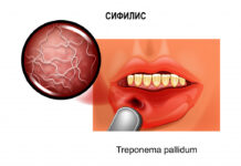 Сифилис — причины появления, симптомы заболевания, диагностика и способы лечения