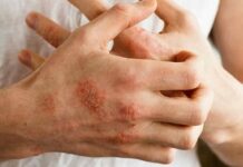 Экзема. Народные средства лечения