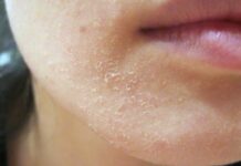 Шелушится кожа на подбородке почему. Почему шелушится кожа на подбородке у женщины | Школа красоты