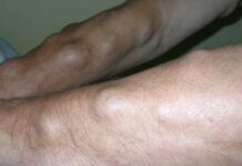 Появилась шишка под кожей, уплотнение): может ли она быть раком — Большереченская ЦРБ. Официальный сайт