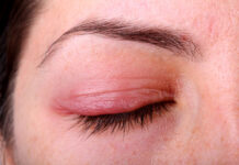 Почему опухают веки и как с этим бороться?