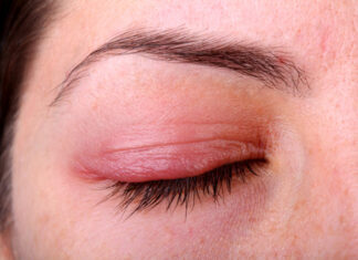 Почему опухают веки и как с этим бороться?