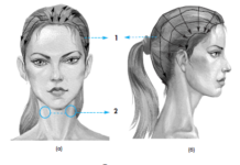 Заболевания кожных покровов волосистой части головы: инфекционные, грибковые, воспалительные — эффективное лечение лазерным аппаратом Рикта