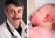 Е. Комаровский: розеола (11 фото): симптомы и лечение детской болезни