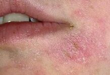 Шелушение кожи на лице: причины и лечение