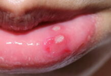 Болячка на губе: виды, причины, фото и методы лечения | Онлайн доктор