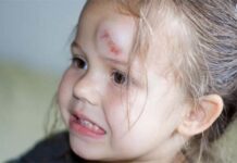 Шишка на лбу у ребенка от удара: что делать и как ее убрать — Городская больница №2