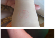 Реакция манту у взрослого: нормы и отклонения