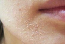 Раздражение на лице покраснение и шелушение. Причины раздражения, шелушения и зуда лица, лучшие мази для лечения | Школа красоты