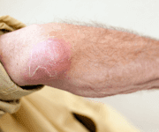 Экзема (мокнущий лишай) — «СМ-Клиника» Санкт-Петербург