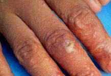 Экзема: признаки, лечение, прогноз — Онлайн-диагностика