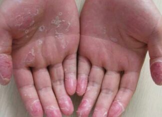 Эксфолиативный кератолиз: причины, симптомы и лечение в статье педиатра Похлебкина А. А.