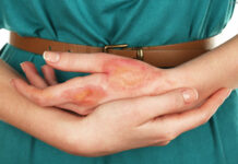 Экзема кожи: 5 правил ухода в период лечения