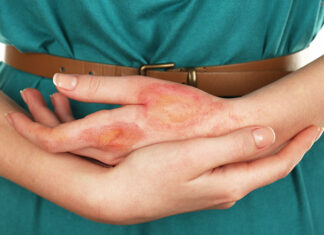 Экзема кожи: 5 правил ухода в период лечения