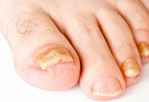 Экзема ногтей: как выглядят ногти, лечение и профилактика, диета