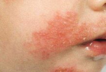 Экзема или лишай: как отличить, диагностика, лечение