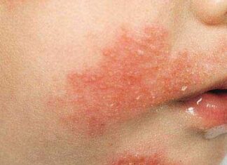 Экзема или лишай: как отличить, диагностика, лечение