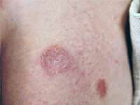 Экзема, лечение и симптомы экземы, причины и формы экземы, фото