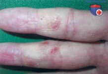 Экзема кистей. Причины красноты, сухости, трещин кистей