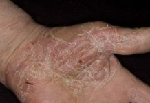 Как восстановить кожу после экземы: эффективные способы избавления от пятен, рубцов, огрубения