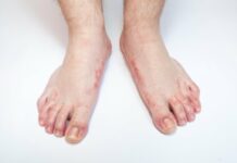 Экзема на ногах. Причины, симптомы, лечение