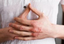 Экзема на руках. Причины, симптомы, лечение