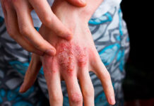Экзема на руках — как лечить