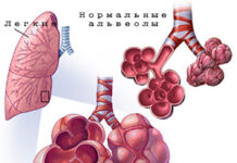 Эмфизема легких. Причины, симптомы, лечение