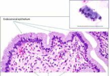 Эрозия шейки матки: лечение, симптомы, причины появления в статье гинеколога Лубнина Д. М.