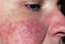 Экзема на лице — эффективное лечение, причины и симптомы заболевания