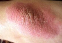 Экзема на локтях — эффективное лечение, причины и симптомы заболевания